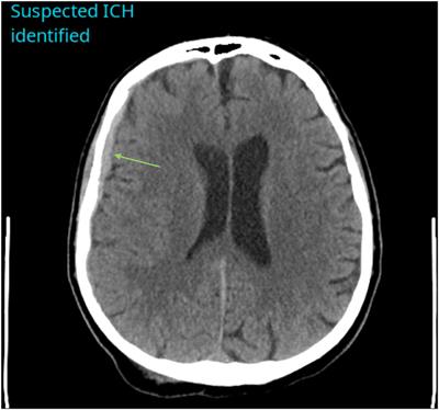 Validation of a Deep Learning Tool in the Detection of Intracranial Hemorrhage and Large Vessel Occlusion